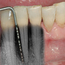 Bentapet bekreftes av et røntgenbilde – skaden er her så stor at tannen må tas bort.