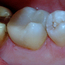 Den gjenstående amalgamfyllingen ble fjernet, og tannen ble bygget opp igjen med en plastfylling.