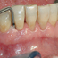 En undersøkelse med lommeregistrering avdekker likevel et omfattende bentap ved den ene tannen.