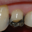 Bildet viser at en tyggeknute til en tann i overkjeven har frakturert. Tannen var svekket på grunn av en stor amalgamfylling.