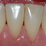Bildet viser forholdene i underkjeven etter at tannstein og misfarging er fjernet.