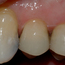 Bildet viser at den gjenstående amalgamfyllingen er fjernet, og at tannen er bygget opp igjen med en plastfylling.