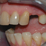 Bildet viser en pasient som mangler en tann i overkjeven. Ettersom nabotennene er uten fyllinger, egner tilfellet seg godt for implantatbehandling.