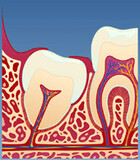 Fig 1: Visdomstenner som er delvis dekket med tannkjøtt, kan være vanskelige å holde rene