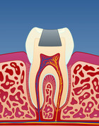Fig 1: I tenner med store fyllinger kan det utvikles sprekker som medfører at tannen knekker