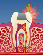 Fig 3: I tenner med store fyllinger kan det utvikles sprekker som medfører at tannen knekker