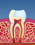 Fig 6: Deretter bygger man opp med en tannfarget fylling i plast (kompositt).