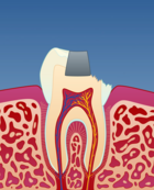 Fig 7: Et porselensinnlegg er et alternativ til tannfargede fyllinger i plast