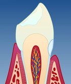 Fig 4: Dersom skaden blir dyp, kan det bli nødvendig å restaurere tannen med en fylling