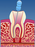 Fig 3: Rotfylling av tann med irreversibel pulpitt