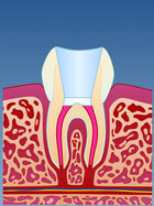 Fig 4: Etter rotfylling kan tannen bygges opp igjen med en tannfarget plastfylling eller en krone