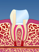 Fig 1: En rotfylt tann er ofte svekket på grunn av store fyllinger og lite gjenværende tannsubstans