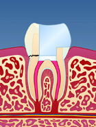 Fig 2: En rotfylt tann vil være mer utsatt for å knekke enn en tann som ikke er rotfylt