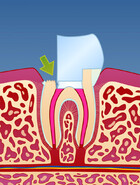 Fig : En rotfylt tann vil være mer utsatt for å knekke enn en tann som ikke er rotfylt
