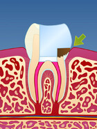 Fig 6: Et dypt hull i tannen kan medføre at bakterier infiserer rotfyllingen på ny 