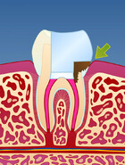 Fig 7: Et dypt hull i tannen kan medføre at bakterier infiserer rotfyllingen på ny 