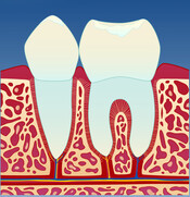 Fig 1: Et friskt tannkjøtt har lys rød farge og ligger stramt inntil tennene