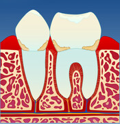 Fig 2: Mangelfullt renhold kan over tid føre til utvikling av gingivitt