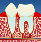 Fig 1: Mangelfullt renhold kan over tid føre til utvikling av gingivitt