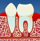 Fig 2: Tannstein forsterker betennelsen som fører til at benet rundt tennene brytes ned
