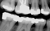  Røntgenbilde av tenner