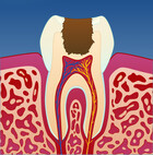 Fig 1: Et svært dypt kariesangrep gir fare for gjennomslag til nerven (pulpa) når hullet renses