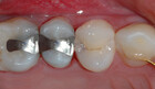 Trinn 1: Eksempel med en tann der kariesangrepet går inn i dentinet