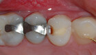 Trinn 2: Man borrer bort den dårlige tannsubstansen og rengjør hullet