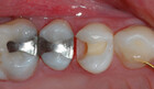 Trinn 3: Man setter på en forskaling (matrise) og klargjør tannen for fylling
