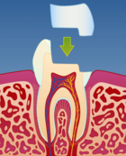 Fig 3: Det tas et avtrykk før tannen dekkes med et midlertidig fyllingsmateriale