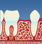 Fig 1: Et implantat opereres inn i kjevebenet der det mangler en tann
