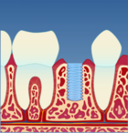 Fig 2: Et implantat opereres inn i kjevebenet der det mangler en tann