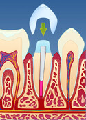 Fig 5: Avtrykk av den beslipte tannen sendes til en tanntekniker som ferdigstiller kronen