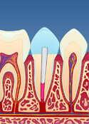 Fig 7: Et rimeligere alternativ vil være å bygge opp tannen med en fylling av kompositt (plast)