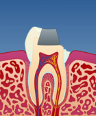 Fig 1: Dersom tannen er svært svekket kan en krone være et alternativ