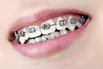 Tannregulering på tennenes forside