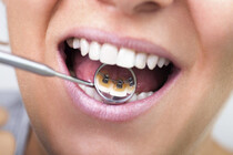 Tannregulering på tennenes bakside