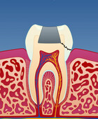 Fig 1: I tenner med store fyllinger kan det utvikles sprekker som forløper på skrå bort fra nerven