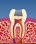 Fig 3: Infraksjonen kan til og med dele tannen i to
