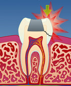 Fig 4: Det vanligste symptomet ved infraksjoner i tenner, er smerter i forbindelse med tygging