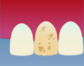 Illustrasjon av tann før behandling