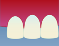 Illustrasjon av tann etter behandling