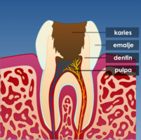 Illustrasjon av tann som trenger rotfylling