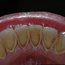 Her kan man se misfarging og tannstein på tennenes innside.