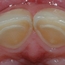 På baksiden av tennene er store deler av emaljen etset bort.