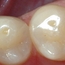Bildet viser små groper i tennene, der emaljen er etset bort.