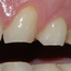 Et detaljbilde viser rette, slitte kanter på tennene.