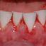 Tannkjøttet blør kraftig når pasienten pusser tennene. Ved godt renhold over tid, vil betennelsen forsvinne.