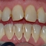 Her kan man se misfarging og tannstein på tennenes fremside.