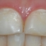Et nærbilde viser at tennene har en matt overflate og områder med et gulere preg.